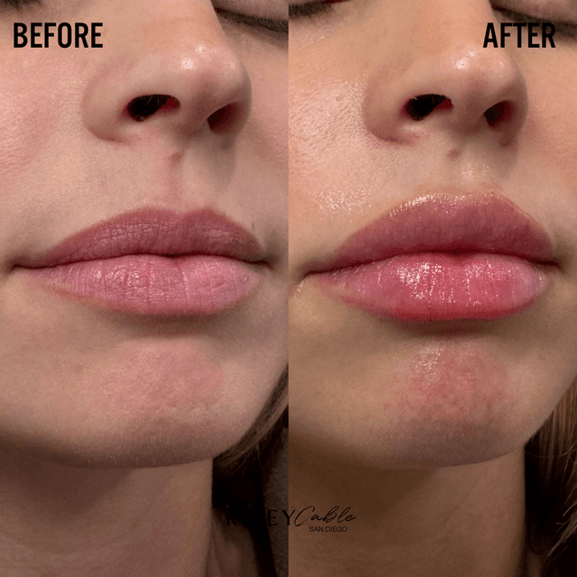 Lip filler injection before and after