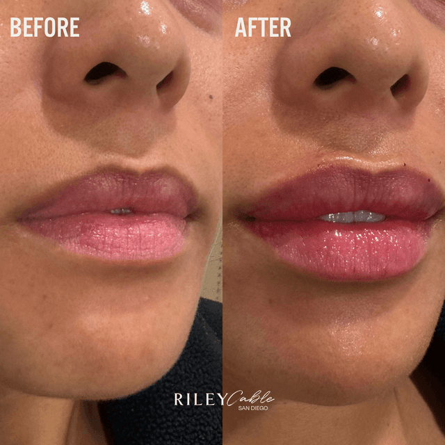 Lip filler injection before and after