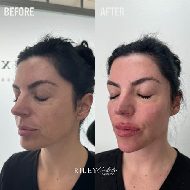 Natural lip filler before and after results for volume and symmetry in Pacific Beach, San Diego by Riley Cable, MSN, RN.