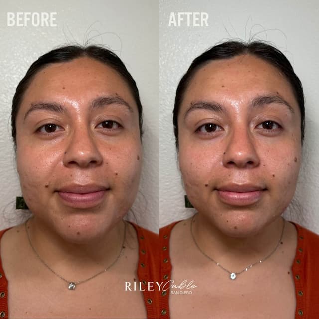 Facial rejuvenation with filler and Botox by Nurse Riley Rx San Diego.